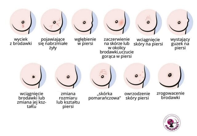 Zmiany świadczące o rozwijającej się chorobie rak piersi - #RóżSięNaBadania akcja moraj