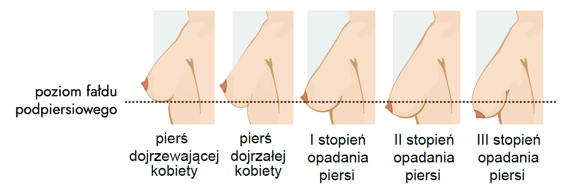 Ptoza piersi - #RóżSięNaBadania akcja moraj